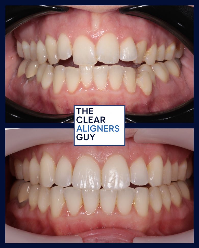 Clear aligner result 4