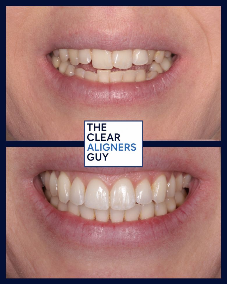 Clear aligner result 5