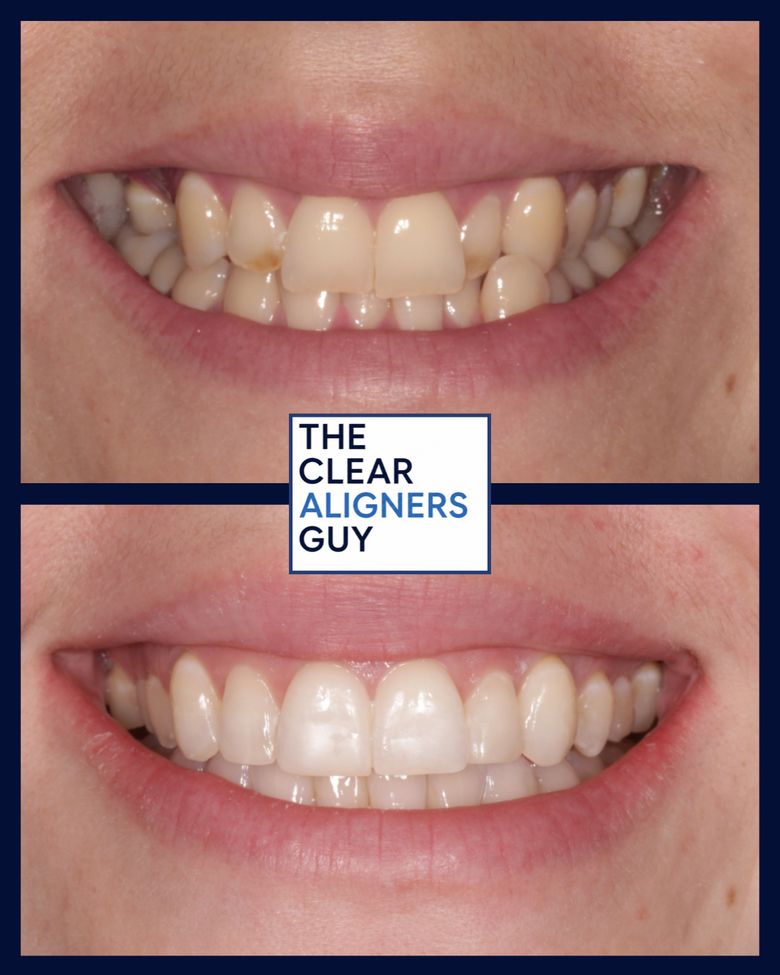 Clear aligner result 6